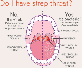 Strep Throat