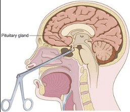 Transsphenoidal Hypophysectomy