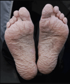 Trench Foot symptoms