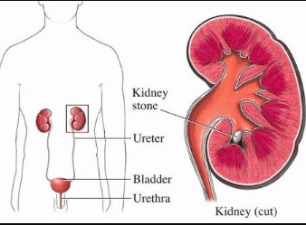 Urosepsis (kidney)