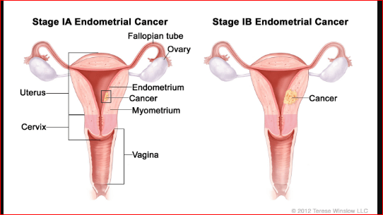 Endometrial Ablation cancer