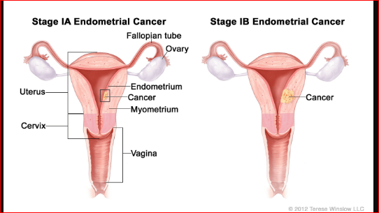 Endometrial cancer