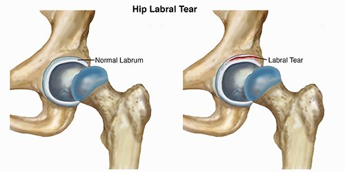 Hip labral tear