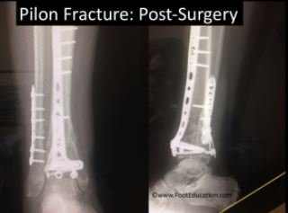 Pilon fracture Post surgery