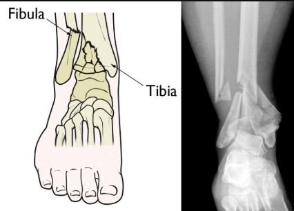 pilon fracture orif cpt