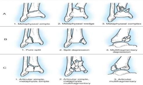 Pilon fracture classification types