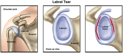 Shoulder Joint labral tear