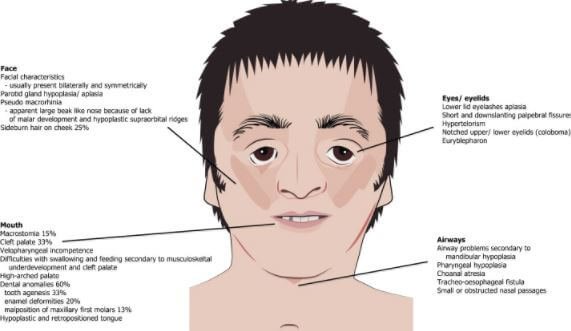 Treacher Collins Syndrome features