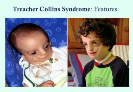 Treacher Collins Syndrome images