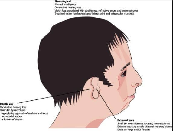 treacher collins syndrome infographic examples