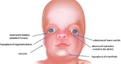 Treacher Collins Syndrome - Pictures, What is, Symptoms, Treatment