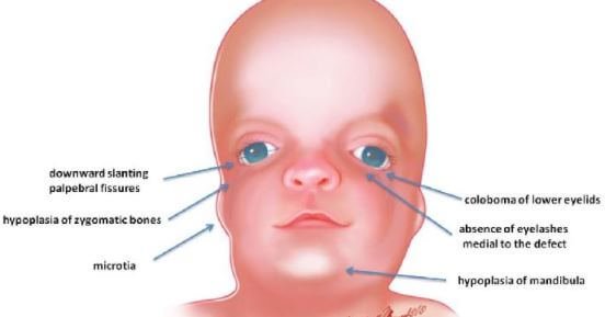 Treacher Collins Syndrome symptoms